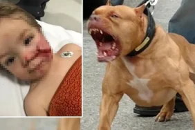 pitbull Dehşeti Çocuğun Yüzü Paramparça Oldu
