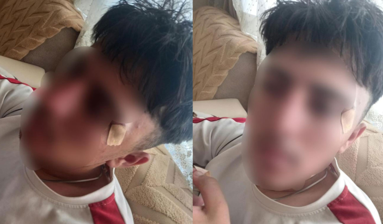 Afyonkarahisar’da öğretmenin kafa attığı çocuğun burnu kırıldı: Soruşturma başlatıldı