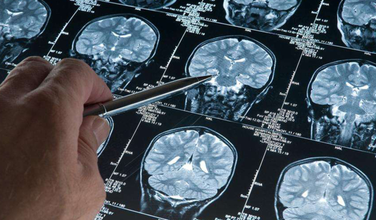 Derin uyku Alzheimer hastalığının ilerlemesini durduruyor